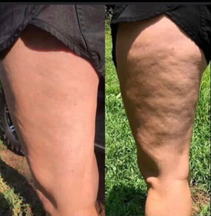 Nutrovio™ Anti-cellulite Massage Oil